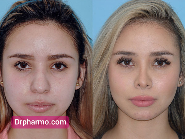 قبل و بعد عمل بینی گوشتی