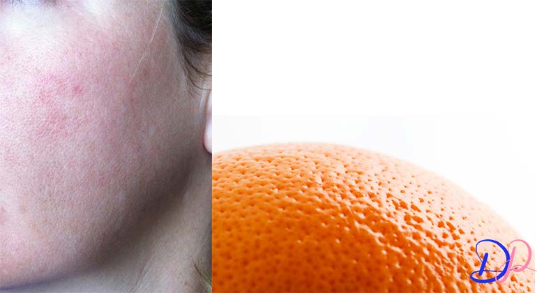درمان پوست پرتقالی