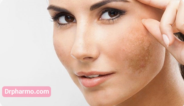 چه عواملی سبب ایجاد لکه های پوستی می شوند؟
