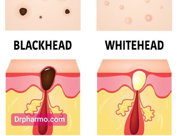 درمان چوش سر سیاه