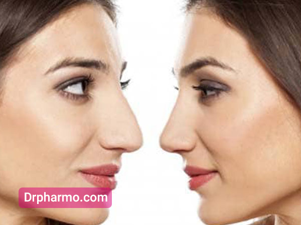 قبل و بعد از عمل زیبایی بینی استخوانی