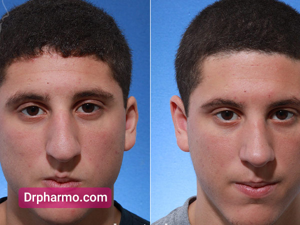 قبل و بعد از جراحی عمل بینی گوشتی