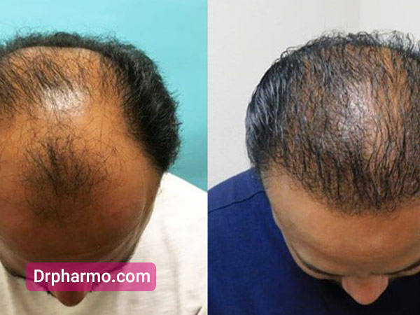 قبل و بعد از کاشت مو به روش fut