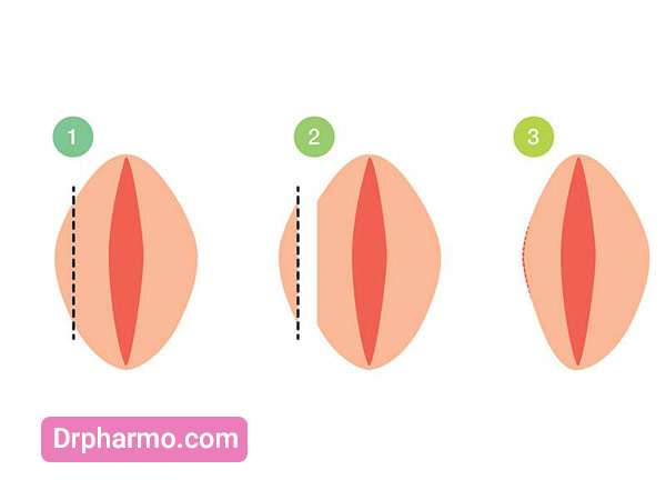 روش های عمل زیبایی واژن