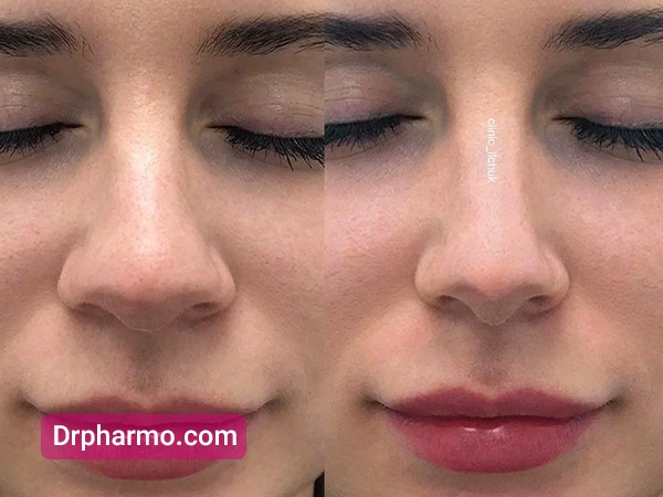 قبل و بعد از جراحی تیپ پلاستی بینی