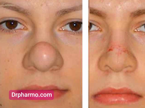 قبل و بعد از عمل تیپ پلاستی بینی 