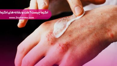 اگزما چیست
