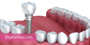 tooth implant 