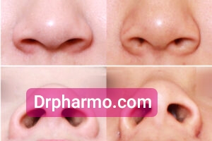 nose job drpharmo