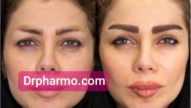 دکتر فارمو کاشت ابرو
