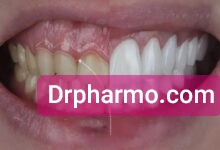 علل لبخند لثه_ای و اصلاح آن با لیفت لثه