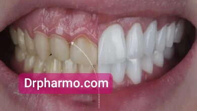 علل لبخند لثه_ای و اصلاح آن با لیفت لثه